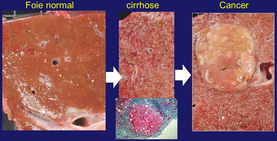 Évolution de la cirrhose en cancer du foie
