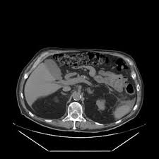 IRM d'un pancréas montrant des calcifications (en haut)